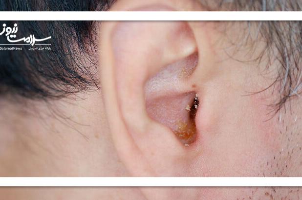 چگونه از تجمع جرم گوش جلوگیری کنیم؟