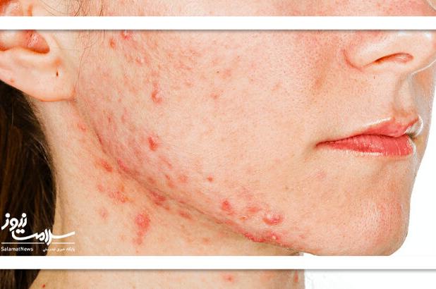 ۷ نشانه مهم که می‌گوید PCOS شما در حال بدتر شدن است