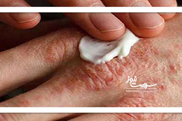 بلایی که خشکی بدن زمستان بر سر بدن می‌آورد