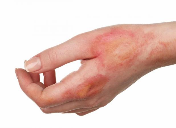 ترمیم جای زخم قدیمی با سلول بنیادی چگونه انجام می‌شود؟ + مزایا و کارکرد