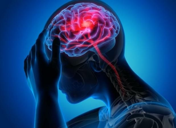 ابتلای ۱.۴ میلیون ایرانی به صرع/ میگرن شایع‌ترین نوع سردرد