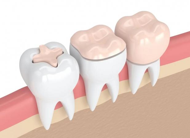 تفاوت اینله و انله دندان با پرکردگی معمولی چیست؟