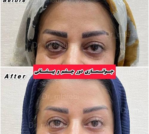 بهترین مرکز تزریق بوتاکس در تهران + معرفی ۱۰ دکتر و کلینیک برتر