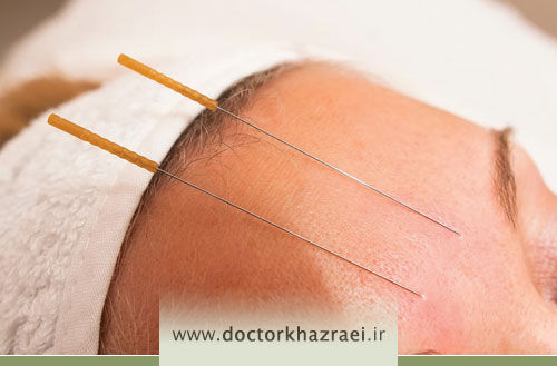 طب سوزنی برای میگرن؛ روشی طبیعی و بی‌عارضه برای کنترل سردردهای میگرنی