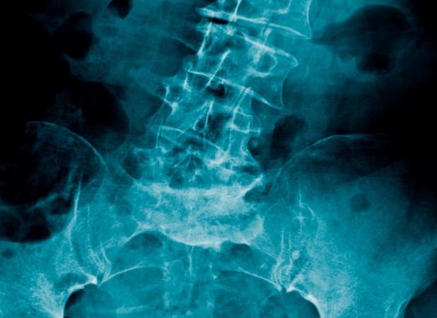 یسک کمر چیست ؟ و روش های درمان دیسک کمر ؟