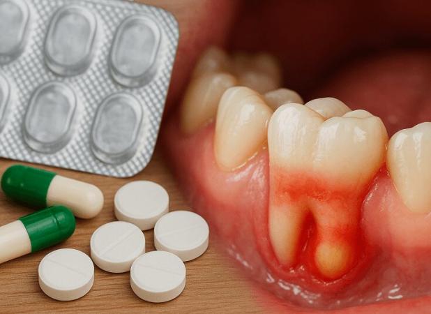 برای عفونت دندان چند روز قرص بخوریم؟