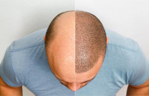 پی آر پی (PRP) بعد از کاشت مو چه فوایدی دارد؟