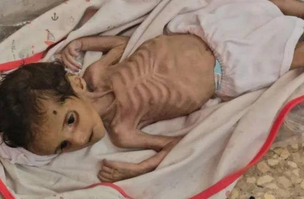 سازمان ملل: گرسنگی در غزه قاتل خاموش است