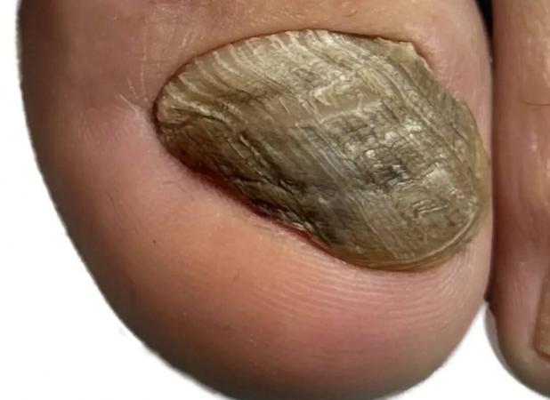 قارچ ناخن علائم، علت‌ها و پیشگیری در مرکز تخصصی پُدولانژ