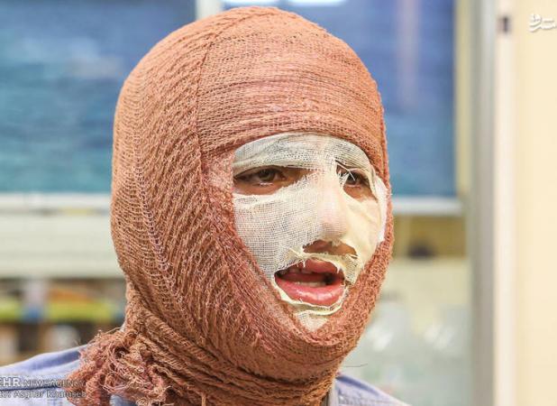 سوختگی در ایران؛ سالی ۳۰۰ هزار سوختگی و زنگ خطر ایمنی