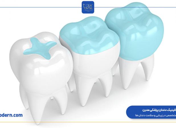 کلینیک مدرن مرکز تخصصی انجام اینلی و آنلی دندان در سراسر ایران