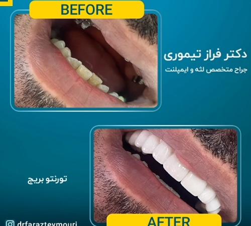 متخصص ایمپلنت با لیزر در کرج | ویژگی‌ها و چگونگی یافتن