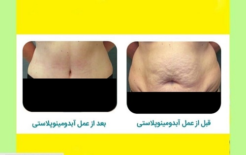 جراحی زیبایی شکم (عمل ابدومینوپلاستی) | مزایا، عوارض و هزینه