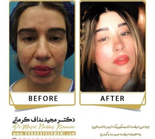 انواع لیفت صورت | بررسی روش‌های مختلف لیفت صورت + جدول مقایسه