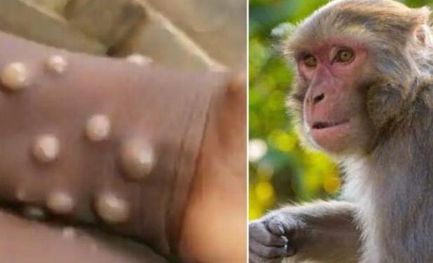 آبله میمونی، ویروسی بدون جهش‌های طولانی مدت/ بیمارستان‌ها  بخش‌های ایزوله تنفسی را احیا کنند