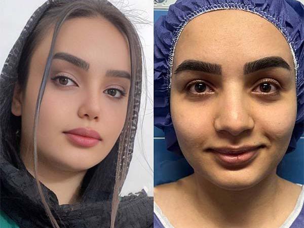 جراحی بینی طبیعی یا نچرال چیست؟ + بررسی کامل به همراه عکس