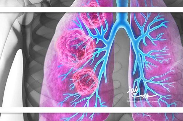 افراد غیرسیگاری در معرض سرطان ریه؛ یک نفر از هر ۵ بیمار غیرسیگاری است