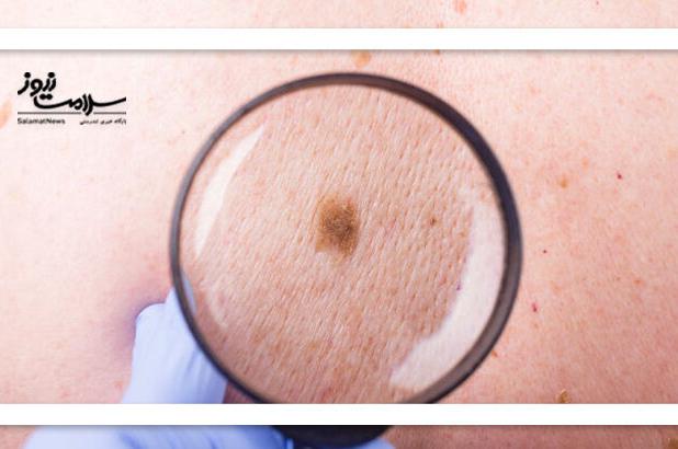 چه کسانی باید مراقب ملانوم باشند؟