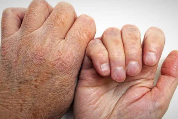 شیوع جذام در کشور کذب است/ کمتر از ۱۰ مورد ابتلا در سال