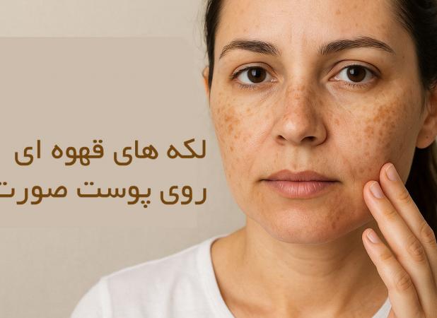 لکه های قهوه ای روی پوست صورت نشانه چیست؟