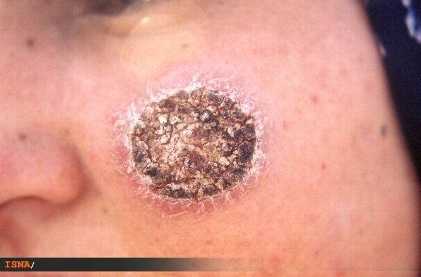 کاهش ۶۰ درصدی ابتلا به سالک در نطنز 