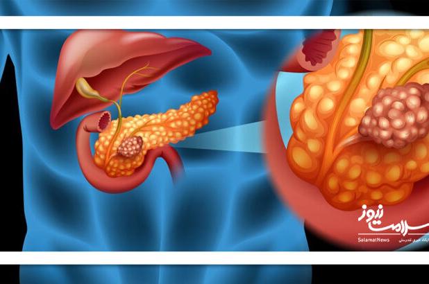 شناسایی علامت هشدار دهنده اولیه سرطان پانکراس، معروف به «قاتل خاموش