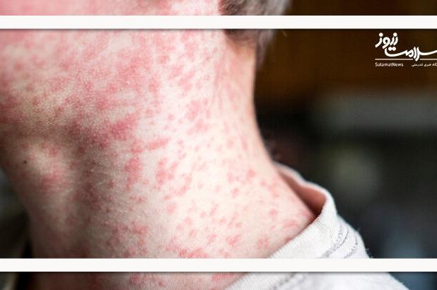 ایران در مسیر حذف سرخک و سرخجه؛ واکسیناسیون کلید کنترل بیماری‌های واگیر