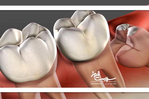 دندان عقل بی فایده یا ارزشمند؟