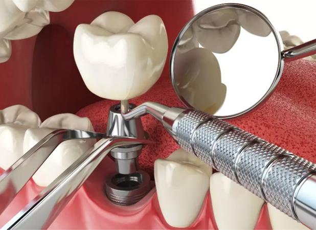 بهترین مرکز تخصصی ایمپلنت در کرج + لیست ۱۰ مرکز برتر