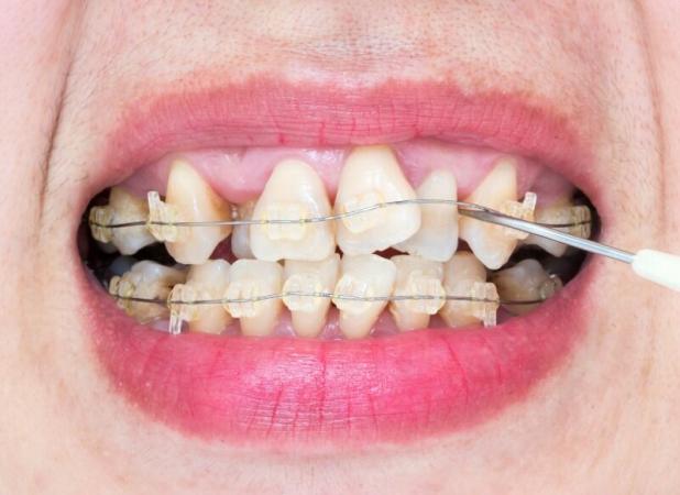 چرا گاهی دندان ها بعد از ارتودنسی باز می گردند؟!