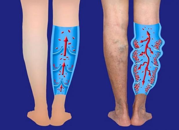 معرفی بهترین قرص‌ ها و پمادهای موثر در درمان واریس