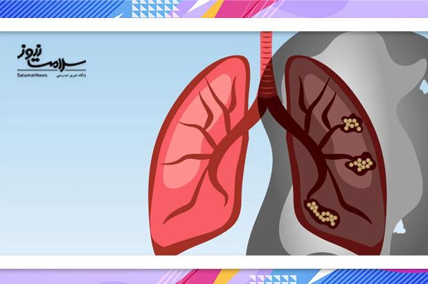 دلایل ابتلا به سرطان ریه در افراد غیرسیگاری