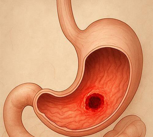 زخم معده و تاثیرات چندلایه آن بر روان انسان