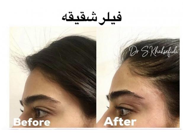 بهترین دکتر تزریق فیلر شقیقه کیست؟ + لیست ۱۰ پزشک برتر