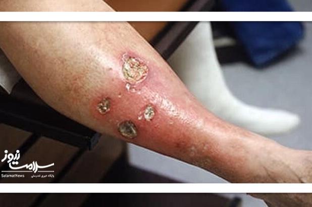 پیشگیری از زخم پای دیابتی؛ مراقبت‌های روزانه و معاینات منظم ضروری است