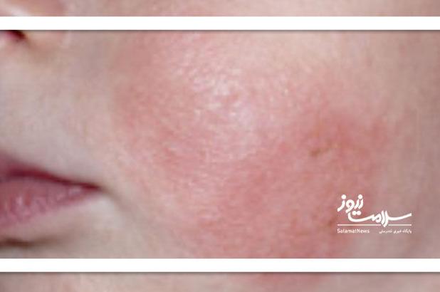 احتمال ابتلای نوزادن به این عوارض پوستی وجود دارد