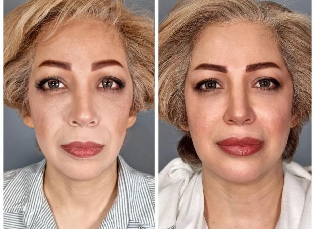 بهترین برند فیلر خط خنده را بشناسید