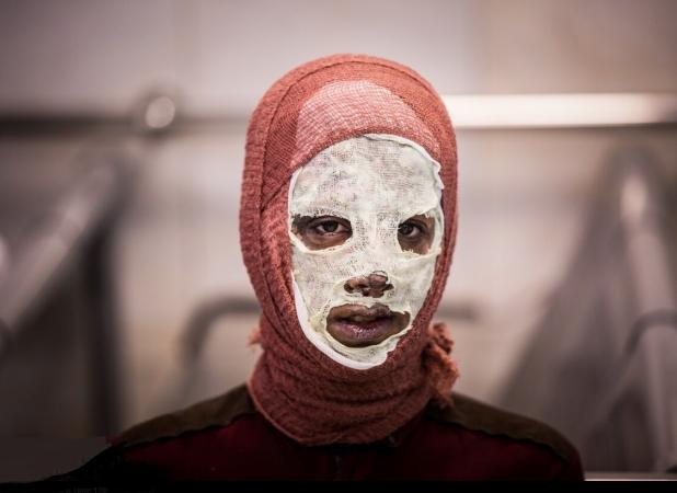 سوختگی؛ از آسیب جسمی تا چالش‌های روانی؛ چرا مراکز استاندارد حیاتی هستند؟