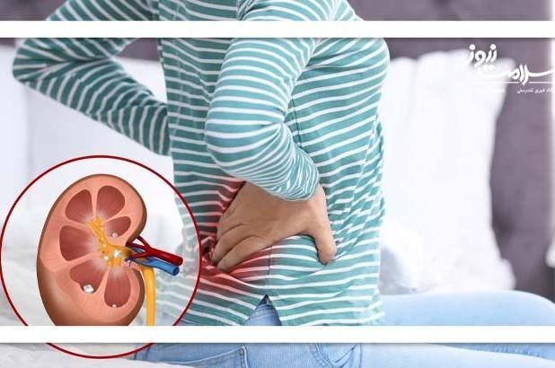 سنگ کلیه؛ دشمن پنهان ورزشکاران