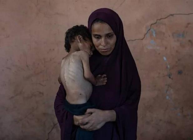 مدیر امداد پزشکی غزه: ۱۷ هزار کودک از سوءتغذیه شدید رنج می‌برند