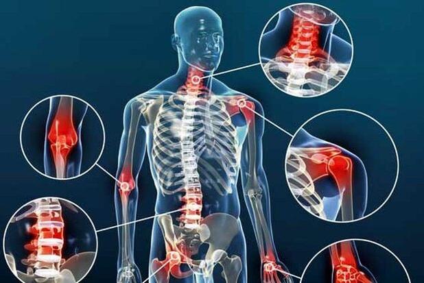 میانه ساز: پیشگیری از آرتروز با ورزش‌ و سبک زندگی سالم امکان‌پذیر است