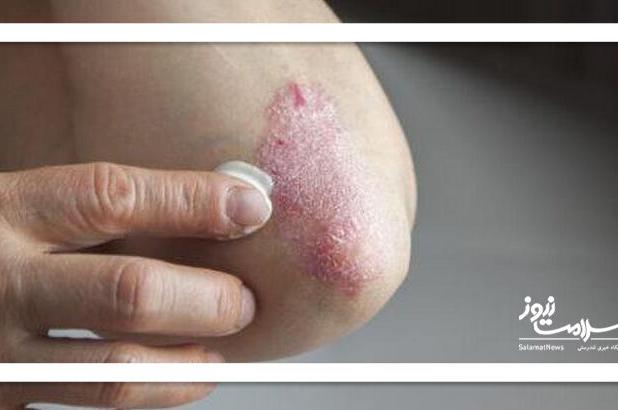 ۱۲ علت شایع پوسته‌پوسته شدن پوست