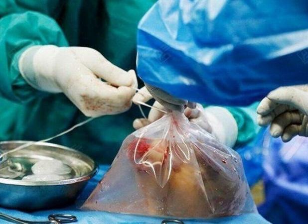 ۸۵ درصد خانواده‌هایی که اهدای عضو را رد می‌کنند، بعدها پشیمان می‌شوند