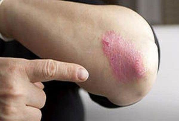 از بیماری «پسوریازیس» چه می دانید