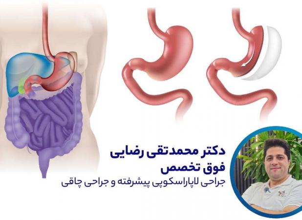 نظر دکتر محمدتقی رضایی متخصص جراحی چاقی در مورد اسلیو معده