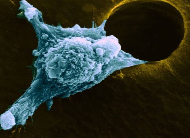 سرطان پایان راه نیست اگر زود تشخیص داده شود