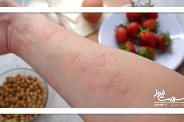 خبر خوش برای کسانی که آلرژی غذایی دارند