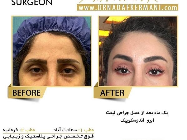 لیفت شقیقه چیست و چه روش‌هایی دارد؟