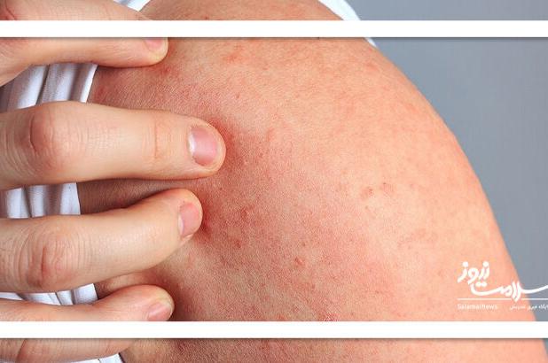 چرا استرس باعث بروز کهیر می شود؟