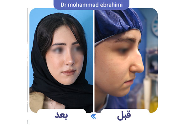 هزینه عمل جراحی بینی در سال ۱۴۰۴ + جدول قیمت